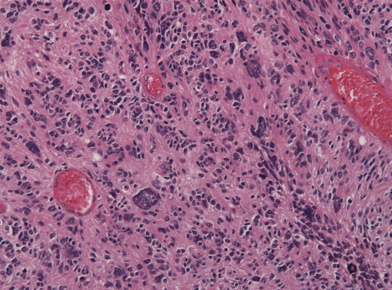 Glioma e Glioblastoma